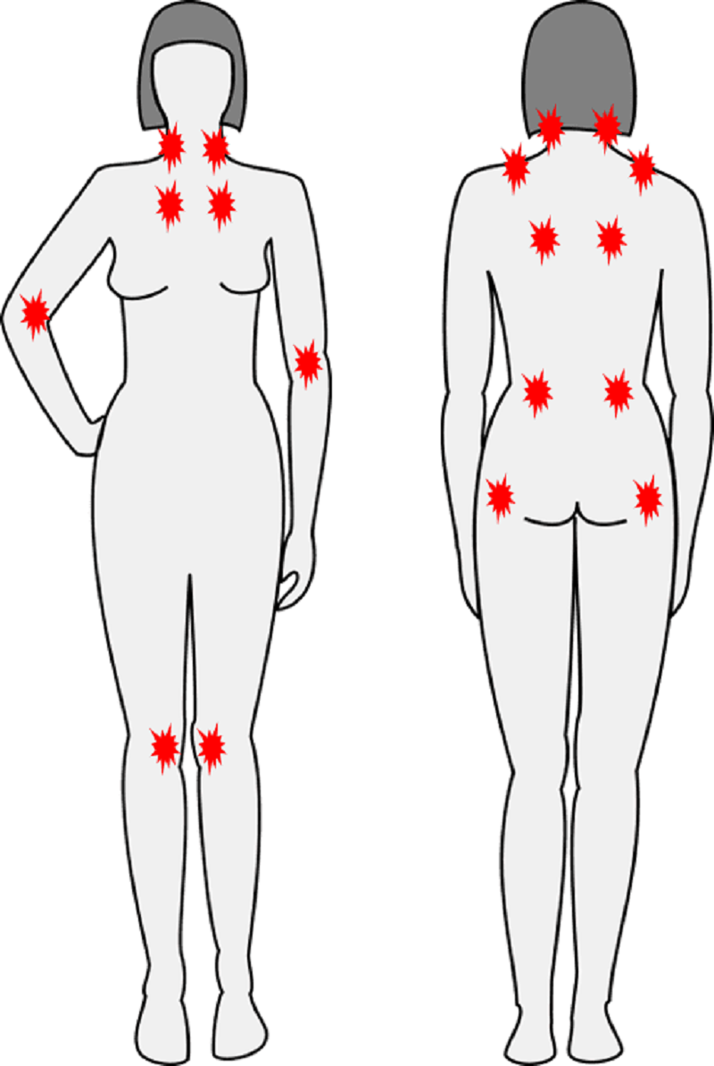 線維筋痛症における18箇所の圧痛点のイラスト