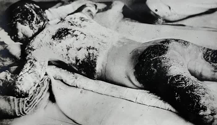 似島に運ばれ、全身にやけどを負った被爆者。1945年8月7日、尾糠政美さん撮影